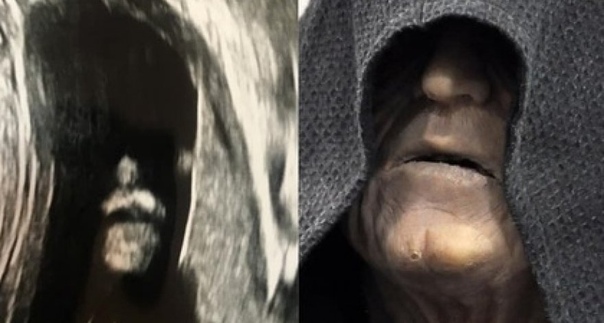 В еще не родившемся ребенке разглядели владыку ситхов На Reddit опубликовали фотографию изображения, полученного на УЗИ беременной женщины. Пользователям имиджборда изображение показалось